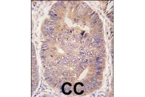 Formalin-fixed and paraffin-embedded human colon carcinoma tissue reacted with hTASP1-C-term (ABIN388126 and ABIN2846334) , which was peroxidase-conjugated to the secondary antibody, followed by DAB staining. (TASP1 antibody  (C-Term))