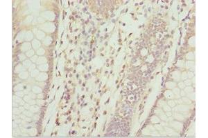 Immunohistochemistry of paraffin-embedded human colon cancer using ABIN7144060 at dilution of 1:100 (ZFAND3 antibody  (AA 1-227))