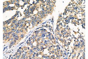 ABIN6259981 and ABIN6276533 at 1/100 staining Human ovarian cancer by IHC-P.