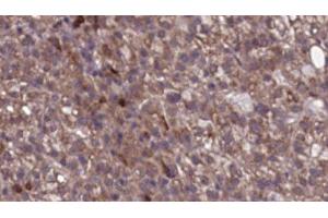 ABIN6276742 at 1/100 staining Human liver cancer tissue by IHC-P. (SCARB1 antibody  (Internal Region))