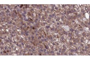 ABIN6276742 at 1/100 staining Human liver cancer tissue by IHC-P. (SCARB1 antibody  (Internal Region))