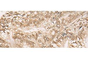 Immunohistochemistry of paraffin-embedded Human gastric cancer tissue using WEE1 Polyclonal Antibody at dilution of 1:35(x200) (WEE1 antibody)