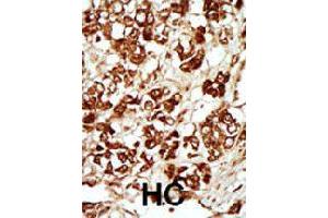 Formalin-fixed and paraffin-embedded human hepatocellular carcinoma tissue reacted with MLKLAK polyclonal antibody  , which was peroxidase-conjugated to the secondary antibody, followed by AEC staining. (ZAK antibody  (Internal Region))