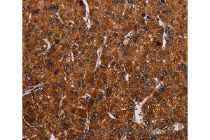 Immunohistochemistry of Human thyroid cancer using RTN4R Polyclonal Antibody at dilution of 1:50