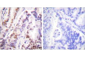 Peptide - +Immunohistochemical analysis of paraffin-embedded human lung carcinoma tissue using HDAC9 antibody (#C0228).