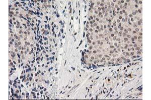 Immunohistochemical staining of paraffin-embedded Adenocarcinoma of Human breast tissue using anti-ADH1B mouse monoclonal antibody. (ADH1B antibody)