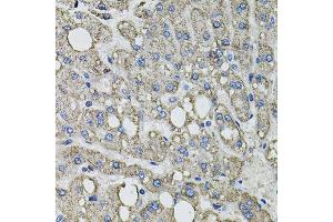 Immunohistochemistry of paraffin-embedded human liver injury using GFPT1 antibody. (GFPT1 antibody  (AA 1-150))
