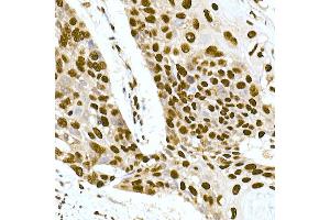 Immunohistochemistry of paraffin-embedded human esophageal cancer using DNA-PKcs Rabbit mAb (ABIN7269665) at dilution of 1:100 (40x lens).