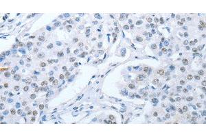 Immunohistochemistry of paraffin-embedded Human breast cancer tissue using ARHGEF2 Polyclonal Antibody at dilution 1:30 (ARHGEF2 antibody)
