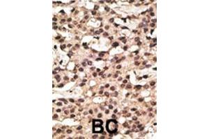 Formalin-fixed and paraffin-embedded human cancer tissue reacted with the primary antibody, which was peroxidase-conjugated to the secondary antibody, followed by DAB staining. (ATG9A antibody  (AA 252-281))