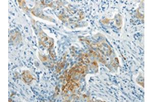 The image on the left is immunohistochemistry of paraffin-embedded Human cervical cancer tissue using ABIN7193069(WNT8B Antibody) at dilution 1/20, on the right is treated with synthetic peptide. (WNT8B antibody)