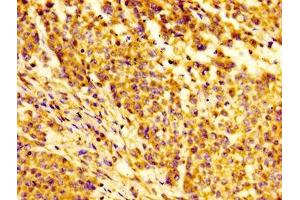 Immunohistochemistry of paraffin-embedded human colon cancer using ABIN7156373 at dilution of 1:100 (IGFBP6 antibody  (AA 32-161))