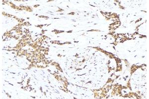 ABIN6275697 at 1/100 staining Human lung cancer tissue by IHC-P. (SLC30A4 antibody  (Internal Region))