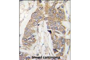 Formalin-fixed and paraffin-embedded human breast carcinoma tissue reacted with CASC3 Antibody , which was peroxidase-conjugated to the secondary antibody, followed by DAB staining. (CASC3 antibody  (C-Term))