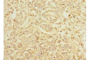 Immunohistochemistry of paraffin-embedded human pancreatic cancer using ABIN7155071 at dilution of 1:100