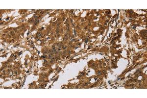 Immunohistochemistry of paraffin-embedded Human gastric cancer tissue using IL19 Polyclonal Antibody at dilution 1:40 (IL-19 antibody)