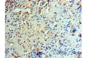 Immunohistochemistry of paraffin-embedded human prostate cancer using ABIN7151466 at dilution of 1:100
