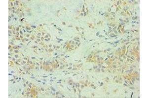Immunohistochemistry of paraffin-embedded human breast cancer using ABIN7157738 at dilution of 1:100 (SPINT1 antibody  (AA 250-529))