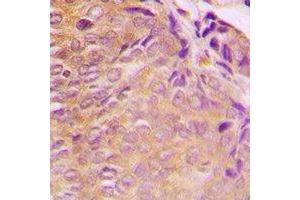 Immunohistochemical analysis of GRB10 staining in human breast cancer formalin fixed paraffin embedded tissue section. (GRB10 antibody  (N-Term))
