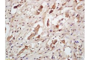 Formalin-fixed and paraffin embedded human lung carcinoma labeled with Rabbit Anti-IGFBP7 Polyclonal Antibody, Unconjugated  at 1:200 followed by conjugation to the secondary antibody and DAB staining