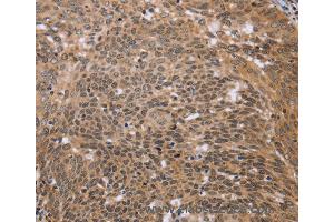 Immunohistochemistry of Human colon cancer using ERCC6L Polyclonal Antibody at dilution of 1:30 (ERCC6L antibody)
