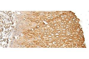 Immunohistochemistry of paraffin-embedded Human esophagus cancer tissue using FAM155B Polyclonal Antibody at dilution of 1:30(x200) (FAM155B antibody)