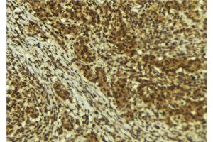 ABIN6273995 at 1/100 staining Human breast cancer tissue by IHC-P. (BRD4 antibody  (N-Term))