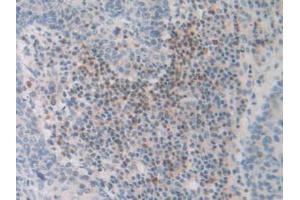 IHC-P analysis of Human Skin Cancer Tissue, with DAB staining. (FDFT1 antibody  (AA 269-417))