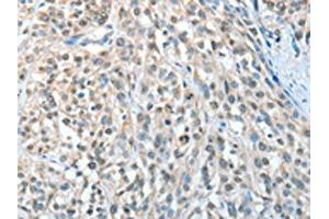 The image on the left is immunohistochemistry of paraffin-embedded Human esophagus cancer tissue using ABIN7128286(AGBL3 Antibody) at dilution 1/25, on the right is treated with fusion protein. (AGBL3 antibody)