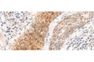 Immunohistochemistry of paraffin-embedded Human esophagus cancer tissue using GHDC Polyclonal Antibody at dilution of 1:90(x200) (GHDC antibody)