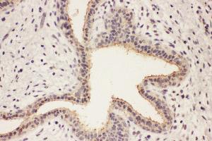 Anti-RAB8A antibody, IHC(P) IHC(P): Human Mammary Cancer Tissue (RAB8A antibody  (C-Term))