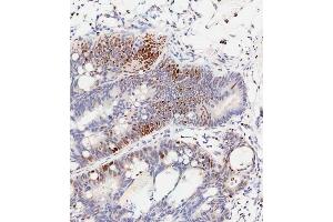 Immunohistochemical analysis of paraffin-embedded Human colon carcinoma tissue using (ABIN389547 and ABIN2839591) performed on the Leica® BOND RXm. (CREB1 antibody  (pSer133))