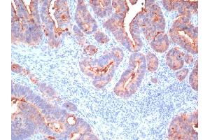 Formalin-fixed, paraffin-embedded human Colon Carcinoma stained with CEA, pan Mouse Monoclonal Antibody (Cocktail) (CEACAM5 antibody)