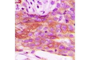 Immunohistochemical analysis of HSL staining in human breast cancer formalin fixed paraffin embedded tissue section. (LIPE antibody  (Center))