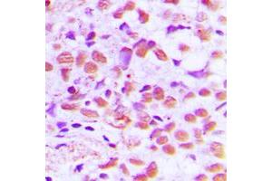 Immunohistochemical analysis of SAE1 staining in human breast cancer formalin fixed paraffin embedded tissue section. (SAE1 antibody  (Center))