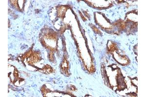 Formalin-fixed, paraffin-embedded human Prostate Carcinoma stained with CD63 Monoclonal Antibody (NKI/C3 + LAMP3/968) (CD63 antibody)