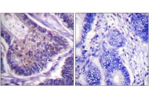 Immunohistochemistry analysis of paraffin-embedded human colon carcinoma tissue, using eIF4B (Ab-422) Antibody. (EIF4B antibody  (AA 388-437))