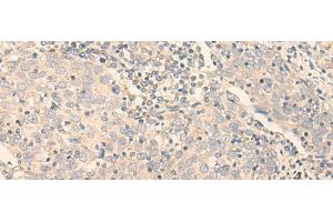 Immunohistochemistry of paraffin-embedded Human cervical cancer tissue using GCDH Polyclonal Antibody at dilution of 1:30(x200) (GCDH antibody)