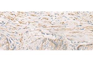 Immunohistochemistry of paraffin-embedded Human prost at e cancer tissue using STOML2 Polyclonal Antibody at dilution of 1:25(x200)