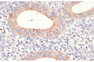Immunohistochemistry of paraffin-embedded Human uterine cancer using HMGCR Polyclonal Antibody at dilution of 1:200 (40x lens). (HMGCR antibody)