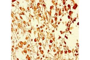 Immunohistochemistry of paraffin-embedded human melanoma using ABIN7174595 at dilution of 1:100