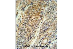 PYCR1 Antibody IHC analysis in formalin fixed and paraffin embedded colon carcinoma followed by peroxidase conjugation of the secondary antibody and DAB staining. (PYCR1 antibody  (C-Term))