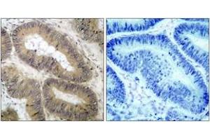 Immunohistochemistry analysis of paraffin-embedded human colon carcinoma, using IKK-alpha (Phospho-Thr23) Antibody. (IKK alpha antibody  (pThr23))