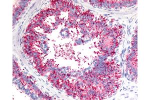 Anti-V1RL1 / VN1R1 antibody IHC of human Breast, Carcinoma.