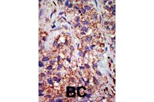 Formalin-fixed and paraffin-embedded human cancer tissue reacted with the primary antibody, which was peroxidase-conjugated to the secondary antibody, followed by DAB staining. (USP8 antibody  (C-Term))
