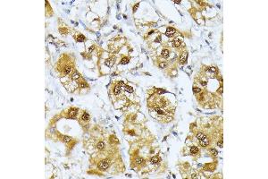 Immunohistochemistry of paraffin-embedded human liver cancer using RRAGD antibody (ABIN6132084, ABIN6147254, ABIN6147255 and ABIN6225325) at dilution of 1:100 (40x lens). (RRAGD antibody  (AA 181-400))