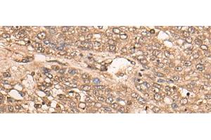 Immunohistochemistry of paraffin-embedded Human liver cancer tissue using B4GALNT2 Polyclonal Antibody at dilution of 1:35(x200) (B4GALNT2 antibody)