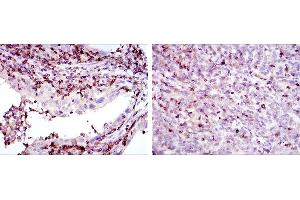 Immunohistochemical analysis of paraffin-embedded endometrial cancer tissues (left) and cervical cancer tissues (right) using GRK2 mouse mAb with DAB staining. (GRK2 antibody)