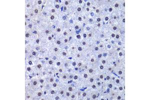 Immunohistochemistry of paraffin-embedded human liver cancer using GSTP1 antibody at dilution of 1:200 (400x lens). (GSTP1 antibody)