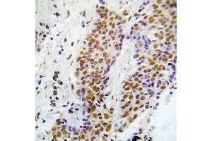 Immunohistochemical analysis of paraffin-embedded human lung adenocarcinoma tissue using ASK1 (Phospho-Ser966) Antibody (E012059). (ASK1 antibody  (pSer966))